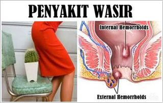 Illustration for article titled Penyakit Wasir Apa Obatnya